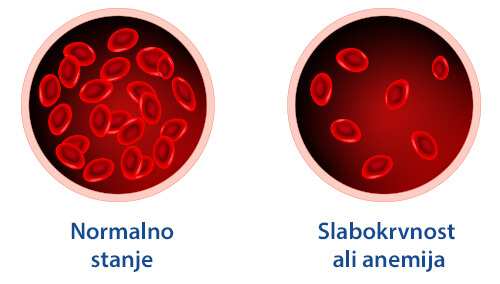 Normalno stanje in slabokrvnost ali anemija